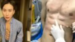Chinese man Andy Hao Tianan showing artificially enhanced eight-pack abs created using hyaluronic acid injections