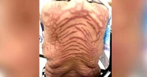 ചൊറിച്ചിൽ മാറാൻ യുവതി ഓൺലൈനിൽ നിന്ന് ക്രീം വാങ്ങി പുരട്ടി; പാമ്പുപോലെ ശരീരം മുഴുവൻ പാടുകൾ, മുന്നറിയിപ്പുമായി ഡോക്ടർമാർ