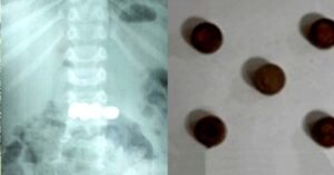 കളിപ്പാട്ടത്തിൽ നിന്നെടുത്ത അഞ്ച് കോയിൻ ടൈപ്പ് ബാറ്ററികൾ വിഴുങ്ങി രണ്ടുവയസുകാരൻ; ഡോക്ടർമാർ പുറത്തെടുത്തത് ഇങ്ങനെ: